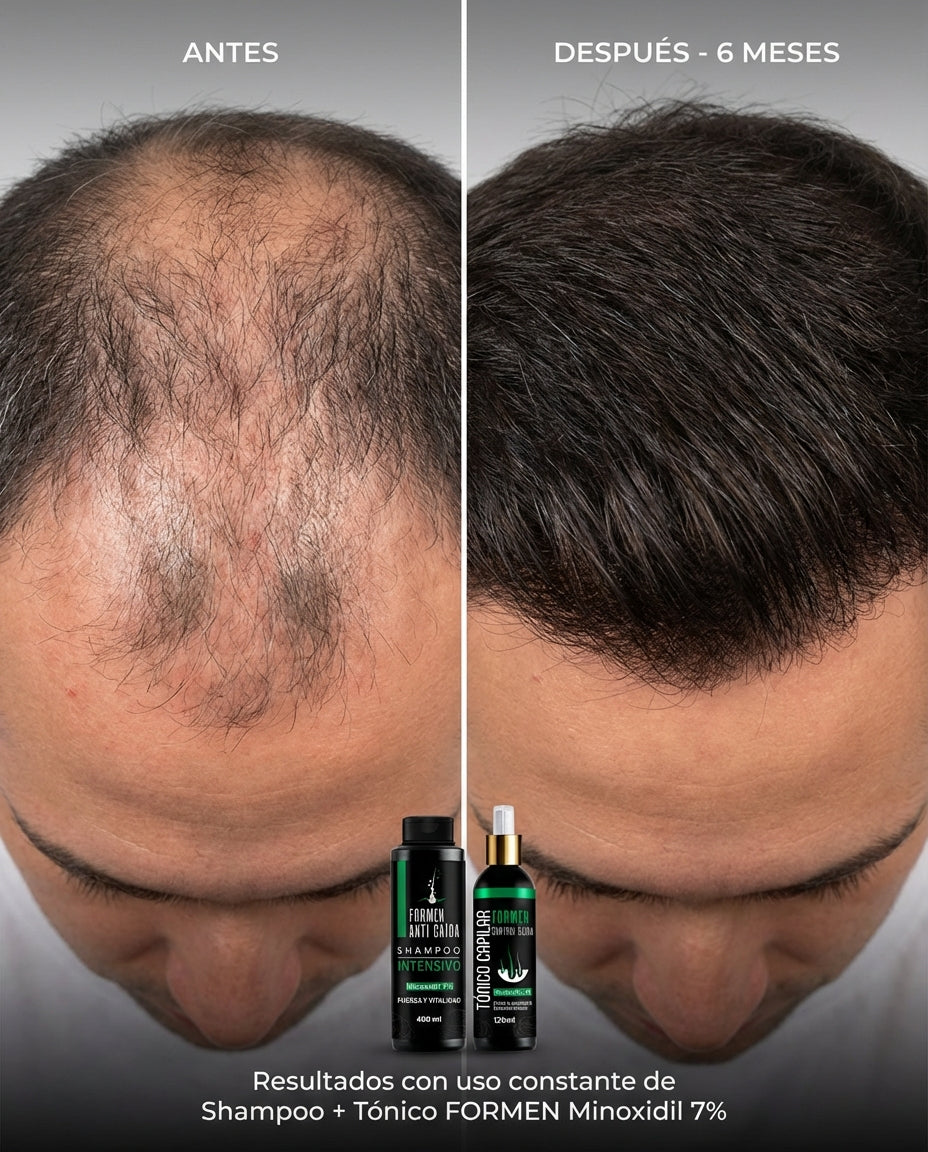 Kit Regeneración Capilar ForMen